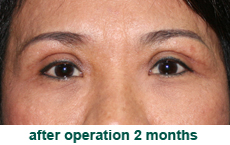 plastic-surgery-blepharoplasty